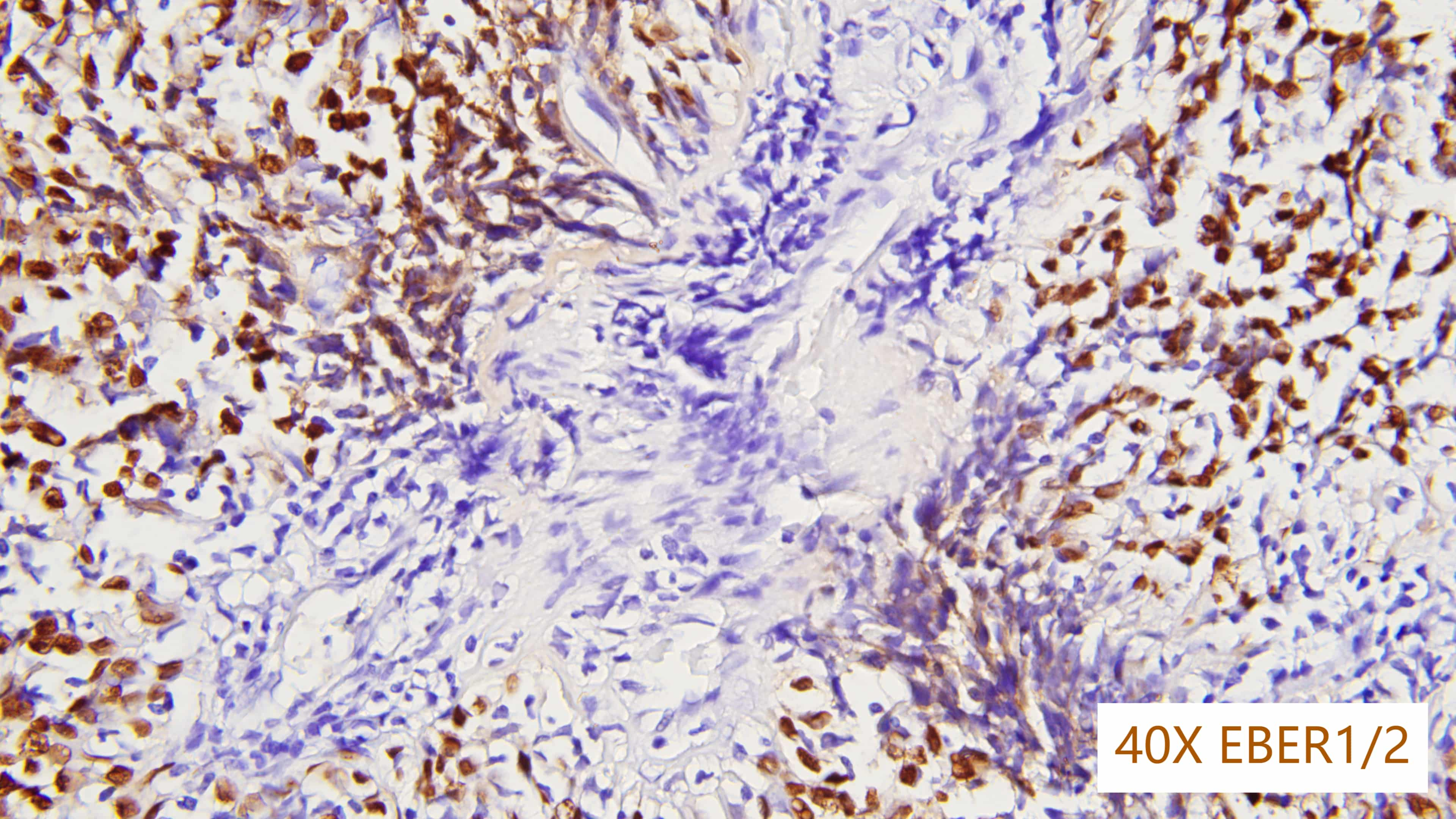 epstein-barr virus,EBv